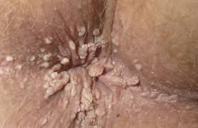 عکس زگیل مقعدی 1