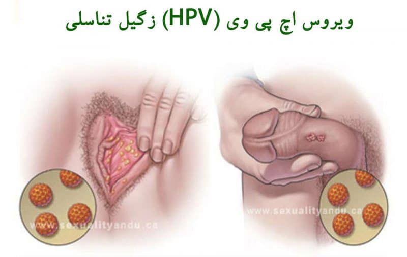زگیل تناسلی یا ویروس اچ پی وی در زنان و مردان