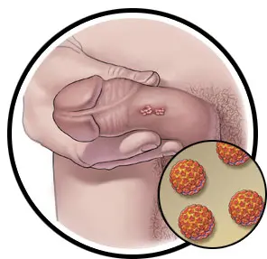 زگیل تناسلی ویروس اچ پی وی HPV در مردان تصویر کوچک 