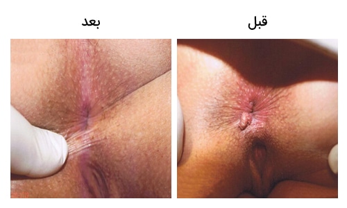 تصویر 27: عکس زگیل تناسلی در زنان درمان با لیزر