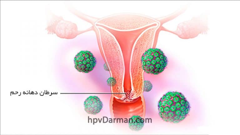 HPV و سرطان دهانه (گردن) رحم