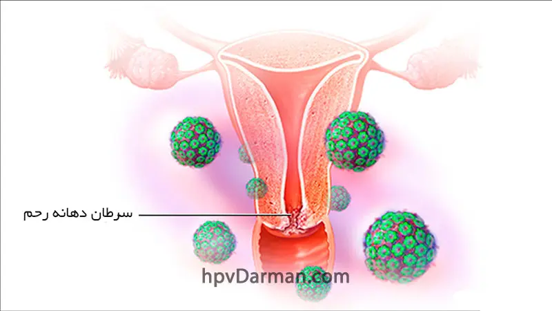 HPV و سرطان دهانه (گردن) رحم