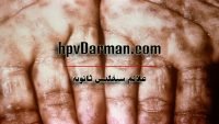 بیماری سیفلیس ثانویه | علائم و چگونگی جلوگیری از انتقال