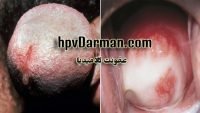 همه چیزهایی که باید درباره عفونت کلامیدیا بدانید !