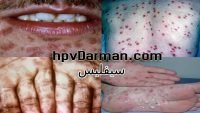 بیماری جنسی سیفلیس Syphilis و شایع ترین علائم آن چیست؟