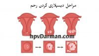 دیسپلازی گردن رحم چیست و از چه طریقی درمان می شود؟