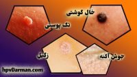 فرق زگیل تناسلی با جوش معمولی چیست؟