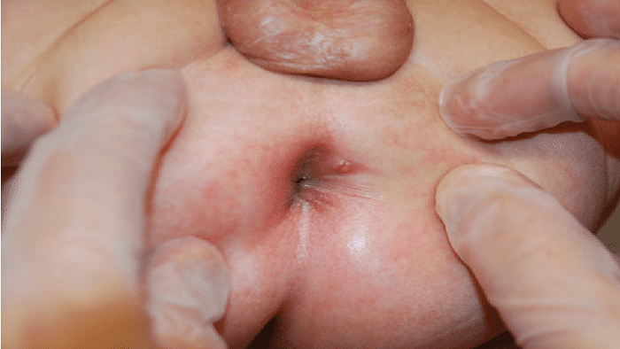شکل فیستول قبل از عود و در مرحله اولیه بیماری
