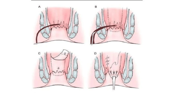 عکس عمل جراحی فیستول با روش فیستولوتومی
