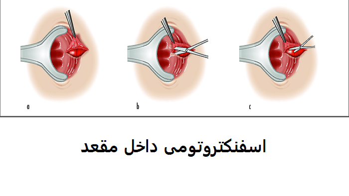 عمل جراحی اسفنکتروتومی