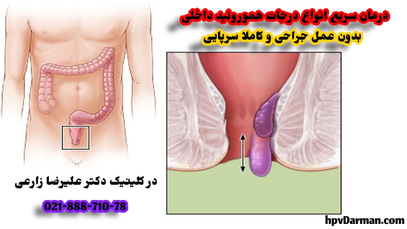 عکس درمان بواسیر داخلی در کلینیک اچ پی وی