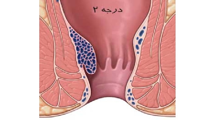عکس هموروئید داخلی گرید 2