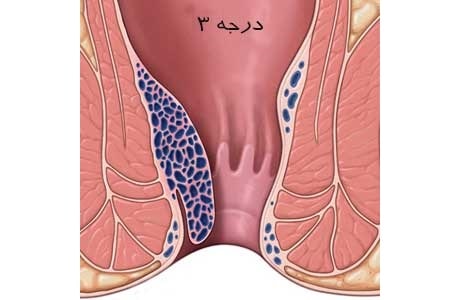 عکس بواسیر داخلی درجه سه 3