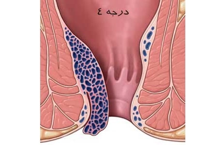 شکل خونریزی هموروئید داخلی گرید 4