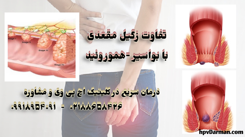 عکس تفاوت زگیل مقعدی با بواسیر