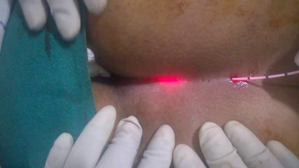 تصویر عبور دادن لیزر زیر پوست برای انجام درمان کیست مویی