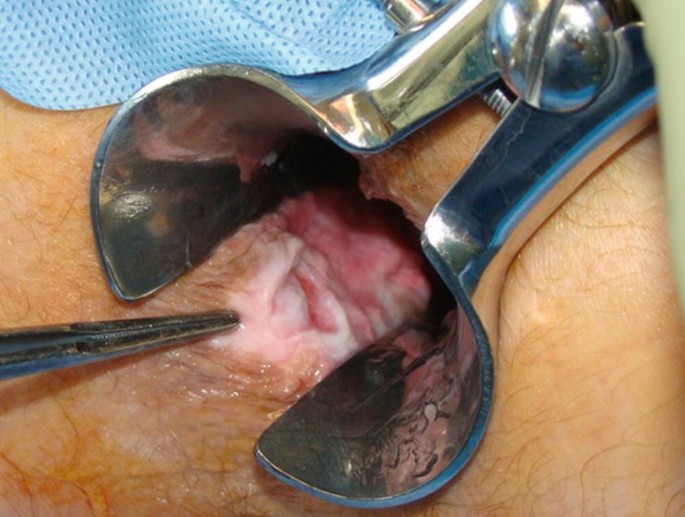 عکس عمل جراحی شقاق با روش اسفنکتروتومی