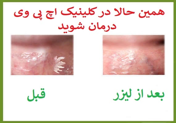 عکس قبل و بعد درمان زگیل تناسلی با لیزر