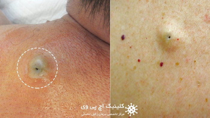 عکس کیست اپیدرموئید