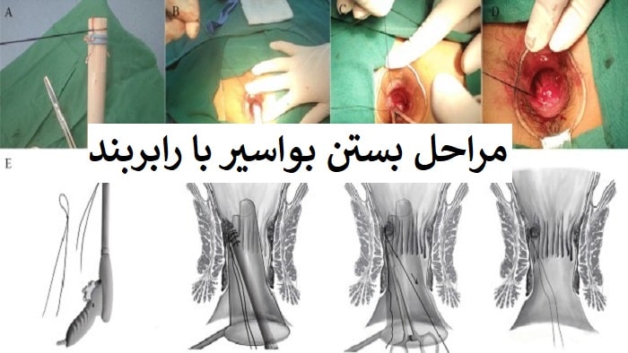 مراحل بستن بواسیر داخلی با رابربند