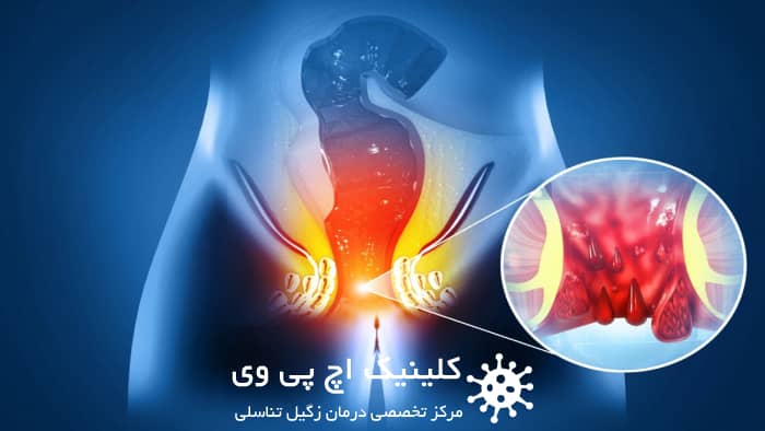 نحوه جلوگیری از عود fistula
