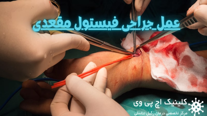 عمل فیستول anal fistula surgery