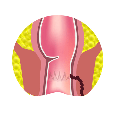 بیماری فیستول مقعدی درمان در کلینیک اچ پی وی