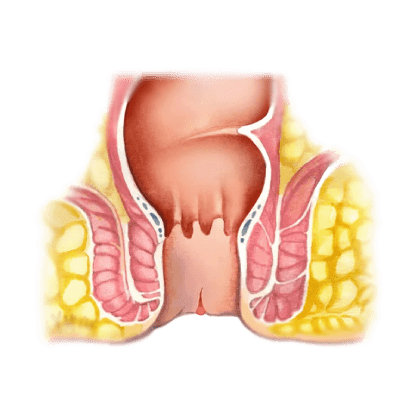 بیماری شقاق مقعدی درمان در کلینیک اچ پی وی