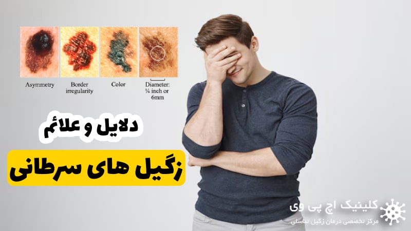 زگیل سرطانی چه علائمی دارد