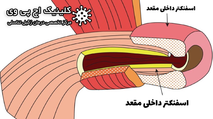 اختلالات اسفنکترهای داخلی و خارجی مقعد