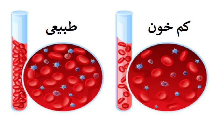 کم خونی یکی از دلایل بیماری بواسیر