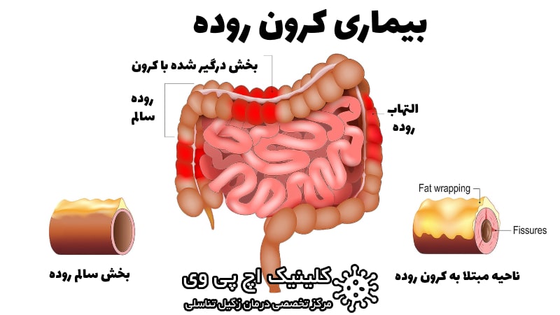 عکس کرون روده