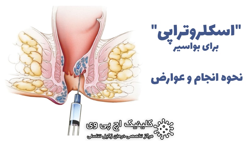 عکس اسکلروتراپی چیست