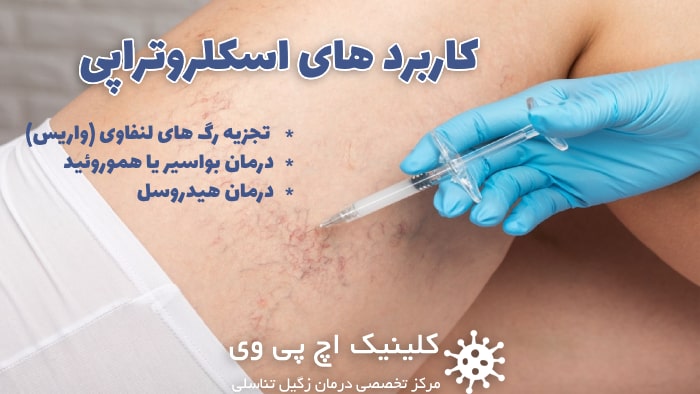 تصویر از کاربردهای اسکلروتراپی sclerotherapy