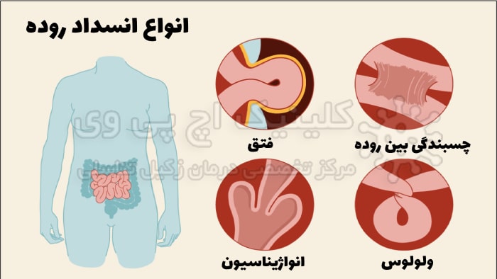 عکس انواع انسداد روده