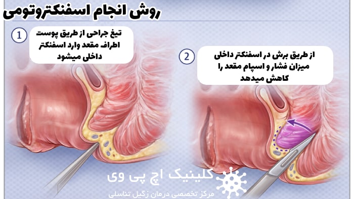 عکس روش انجام اسفنکتروتومی مرحله 1 و 2