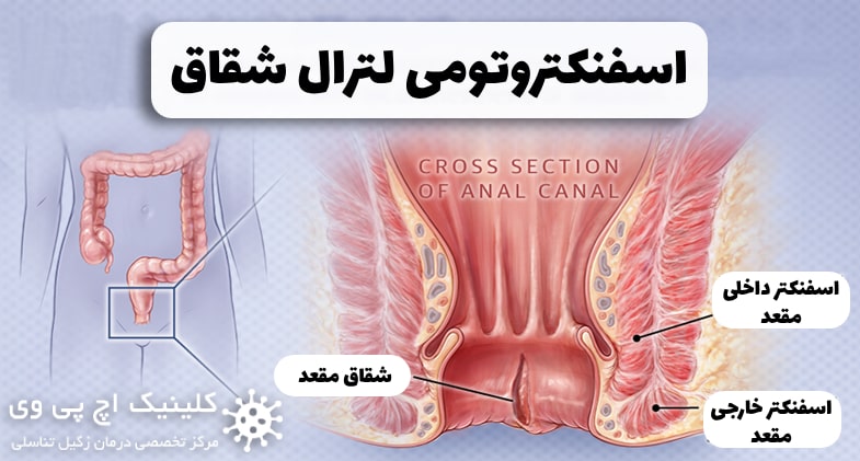 عمل جراحی اسفنکتروتومی