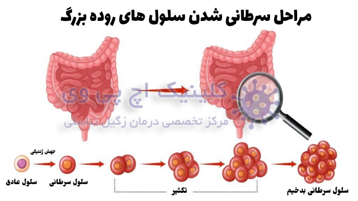 تصویر از مراحل سرطانی شدن سلول های روده بزرگ