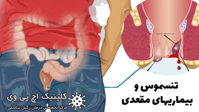 رابطه تنسموس و بیماریهای مقعدی