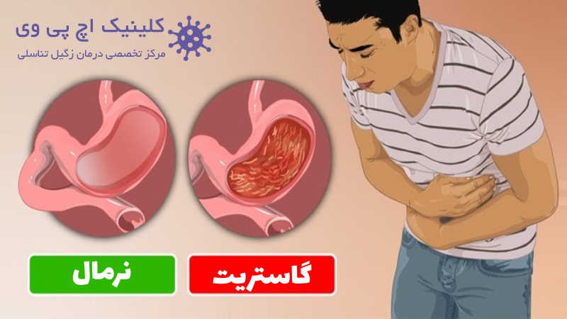 عکس بیماری گاستریت معده چیست