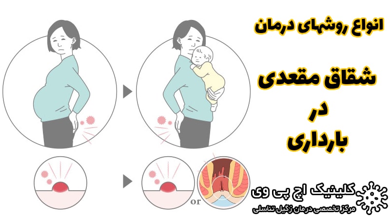 عکس شقاق مقعدی در بارداری