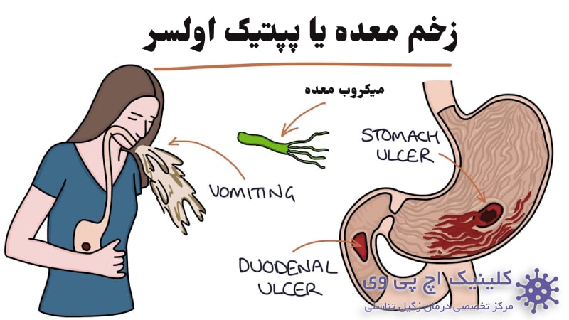 عکس زخم معده کلینیک اچ پی وی