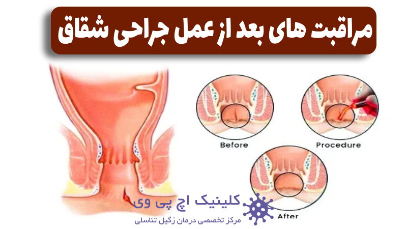 عکس مراقبت های بعد از عمل شقاق