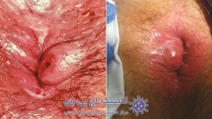 عکس واقعی هموروئید عفونت کرده