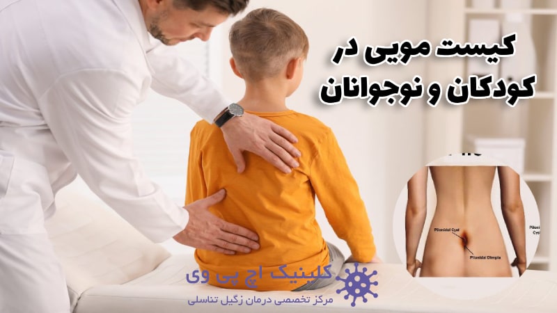 عکس کیست مویی در کودکان و نوجوانان