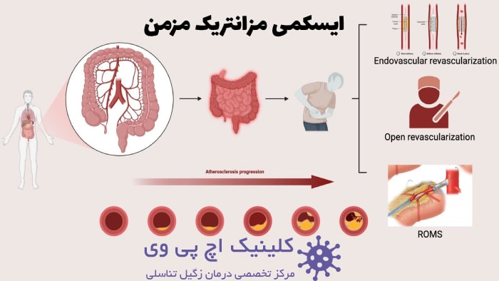 تصویر ایسکمی مزانتریک روده مزمن