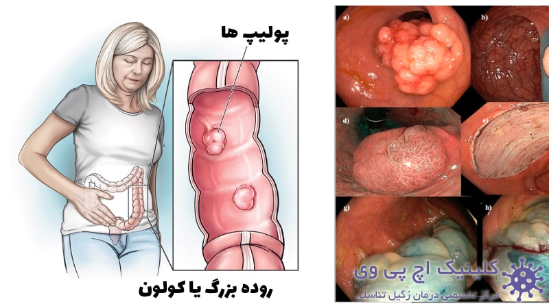 عکس پولیپ روده