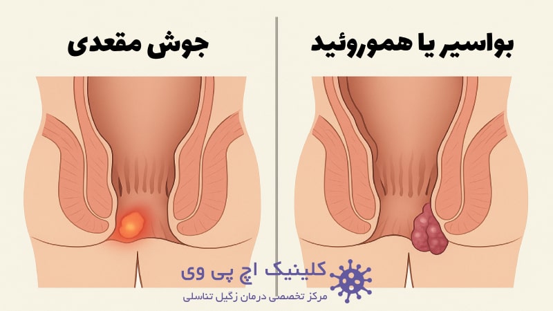 عکس فرق جوش مقعدی با بواسیر