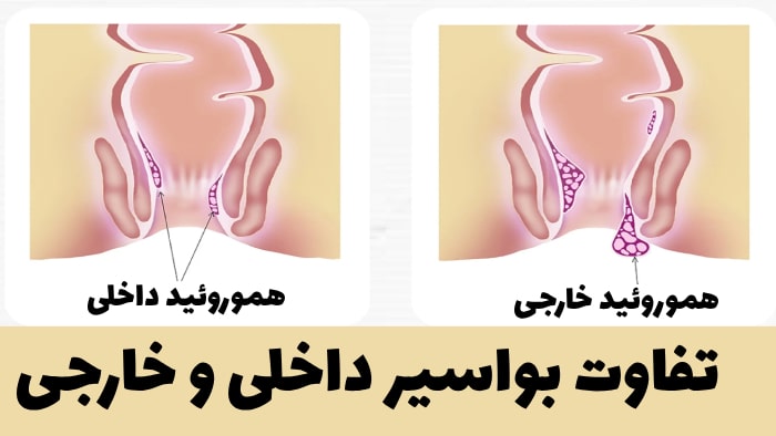 عکس تفاوت بواسیر داخلی و خارجی
