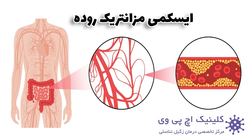 عکس ایسکمی مزانتریک روده
